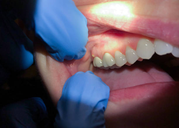 Best Emergency Dental Filling Replacement  in Splendora, TX